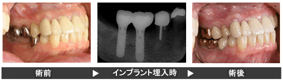 インプラント治療例